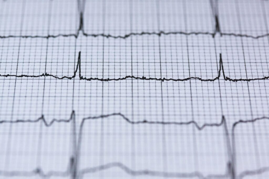 Vandalia Health Mon Medical Center first in U.S. to use new AI-assisted technology during heart rhythm procedure in tandem with new ablation technology